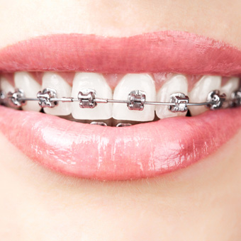 Fixed metal braces