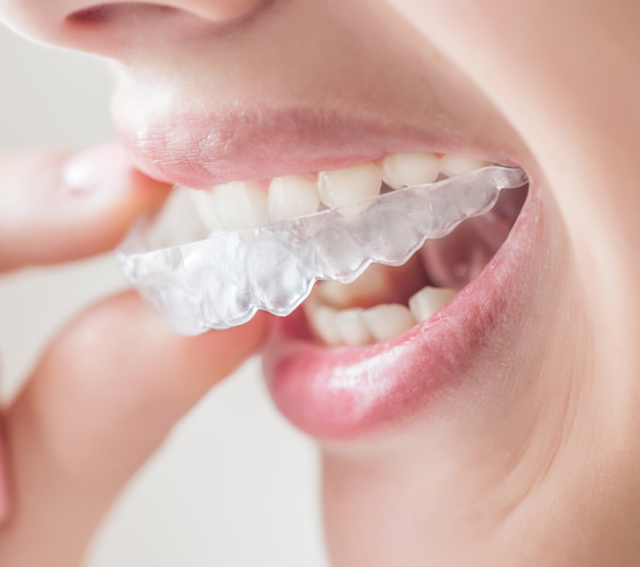 Invisalign for adults